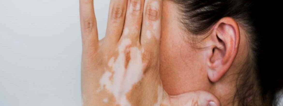 Vitiligo and Hearing Loss