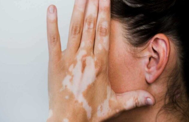 Vitiligo and Hearing Loss